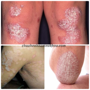 Bệnh vẩy nến