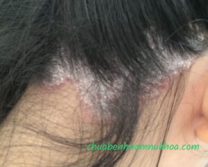 bệnh vẩy nến